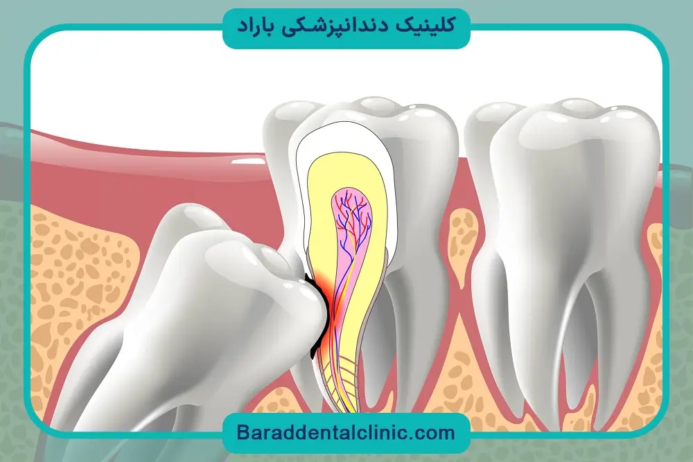 انواع بی‌حسی و بیهوشی برای جراحی دندان عقل 