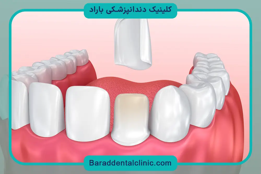 طراحی لبخند دیجیتال در بهترین کلینیک کامپوزیت تهران 
