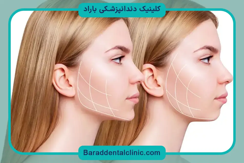 تثبیت فک در عمل جراحی فک بالا 