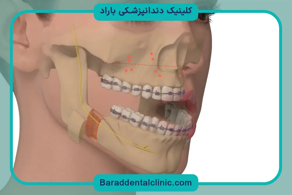مراحل عمل جراحی فک پایین 
