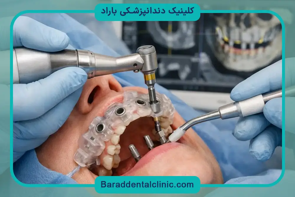 تاثیر پیوند استخوان روی قیمت ایمپلنت دیجیتال در تهران 