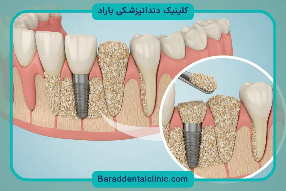 مراحل ایمپلنت اقساطی با سفته 
