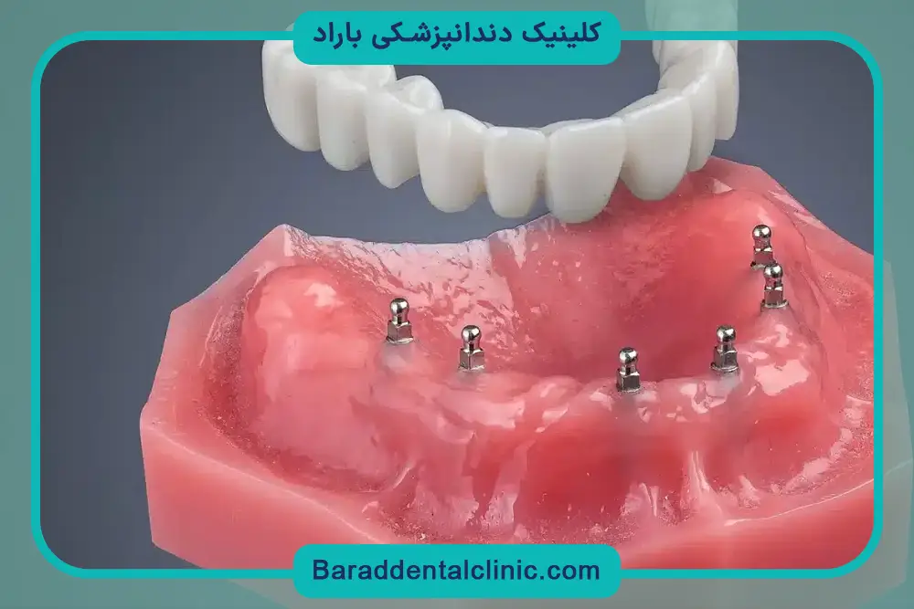 ایمپلنت دندان چقدر طول میکشد؟ بررسی عوامل موثر